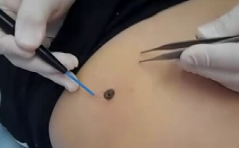 激光去痣治疗过程