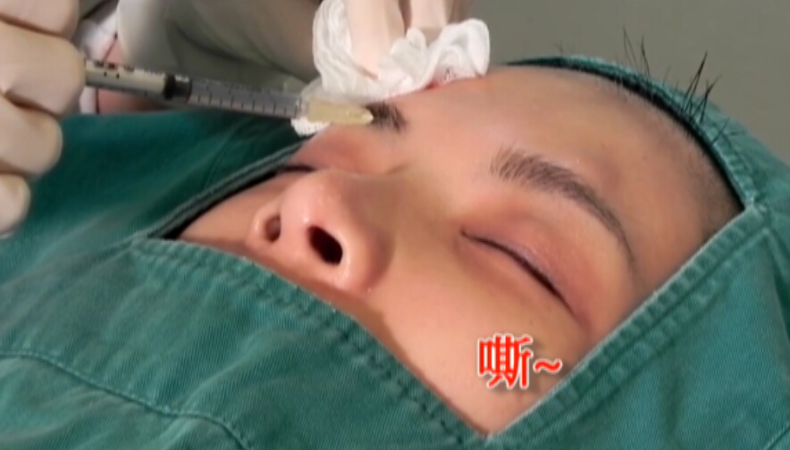 眉眼提拉埋线实操视频