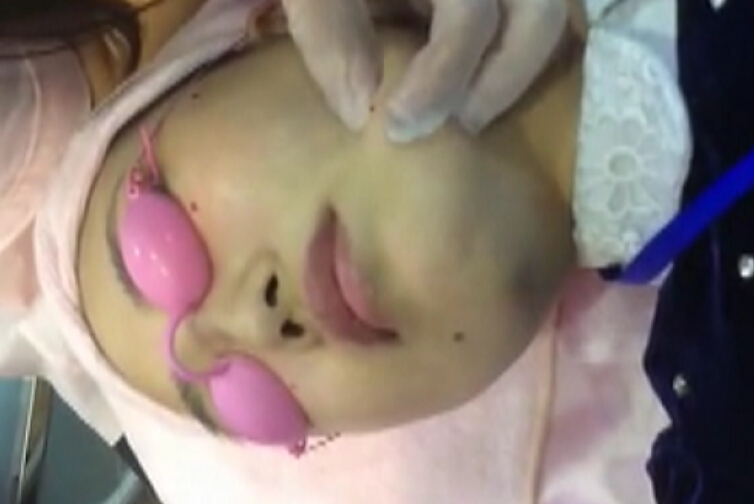 真人体验激光点痣