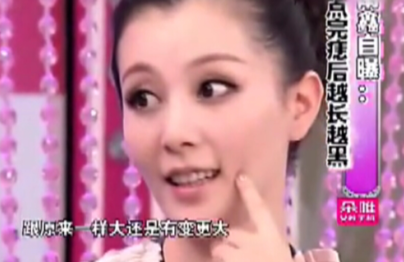 专家解说点痣不当的严重后果