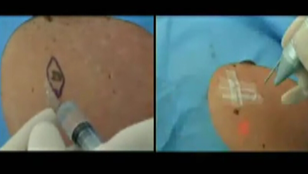 手术切除去痣操作过程演示