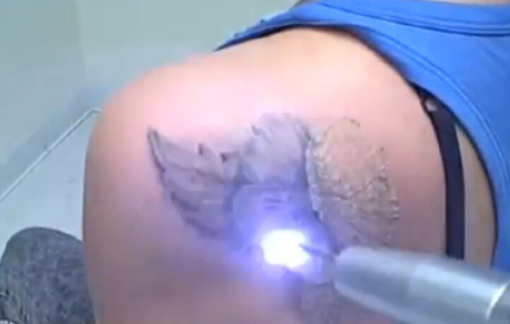 激光治疗肩部纹身