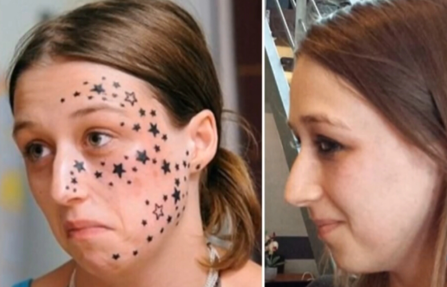 9次激光手术去除脸部纹身
