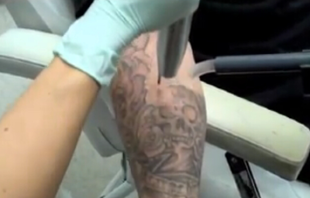 激光去除手臂纹身