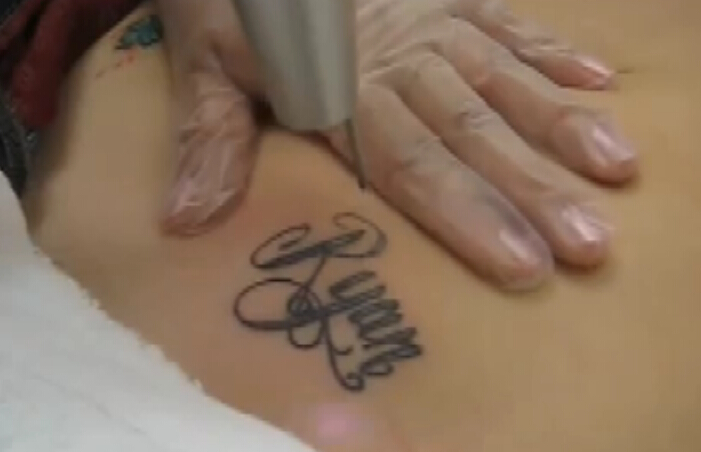 激光去除腹部纹身