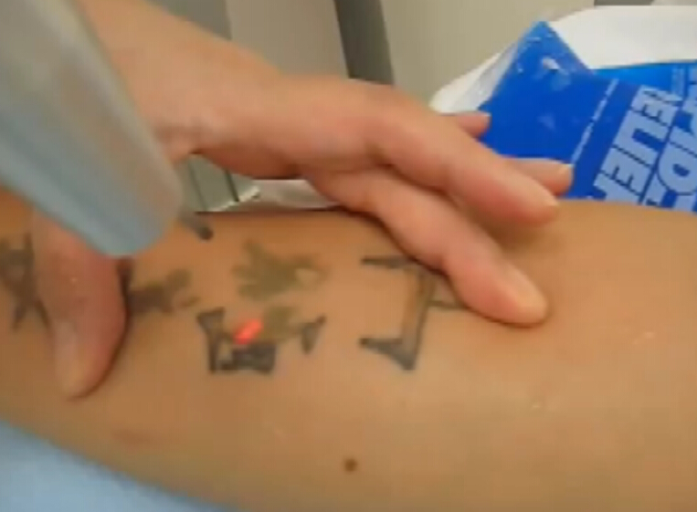 如何利用激光去除纹身