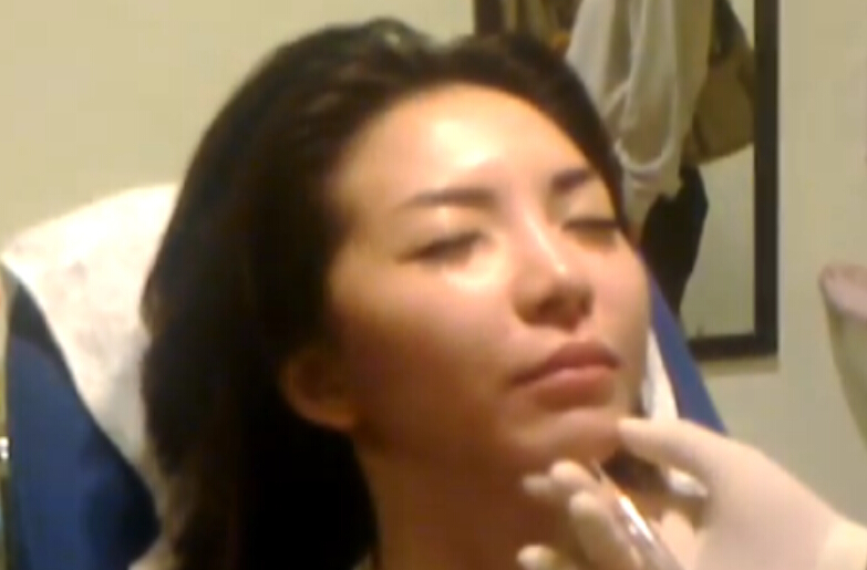 玻尿酸注射隆下巴真人体验