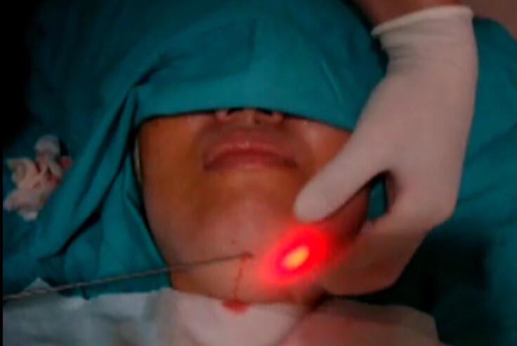 整形美容激光溶下巴