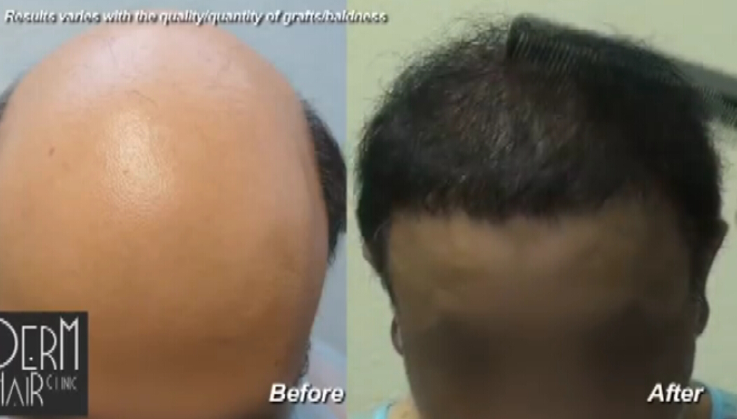 头发恢复和严重脱发-体毛移植