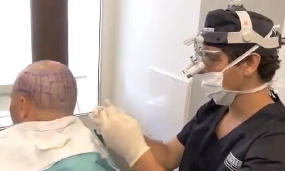 Hair transplantation毛发移植