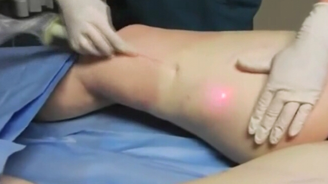 整形美容激光吸脂