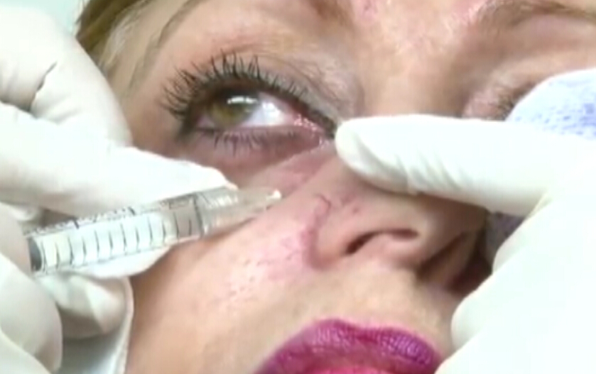 专家演示泪沟注射填充过程