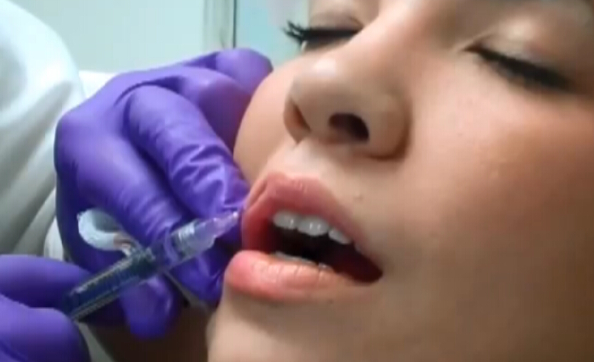 乔雅登玻尿酸注射丰唇