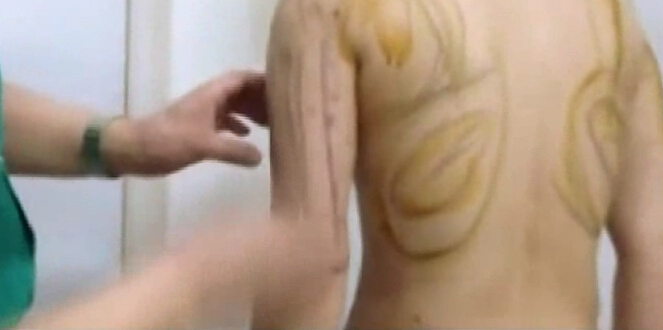 360°环形立体定位吸脂操作