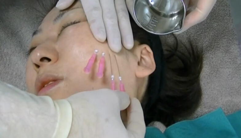面部埋线提升实操真人演示