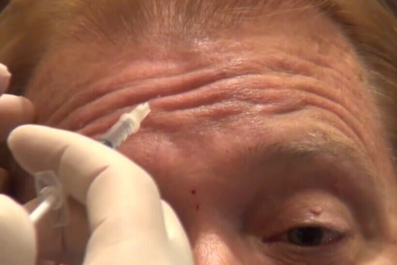 肉毒杆菌去除抬头纹