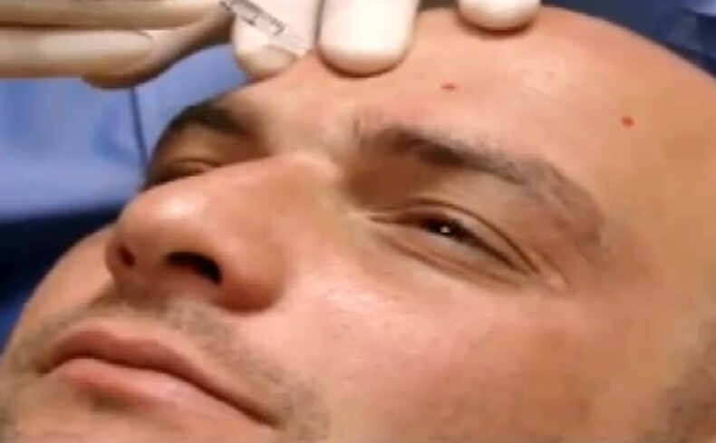 抗皱注射液作为骨胶原抗皱修护