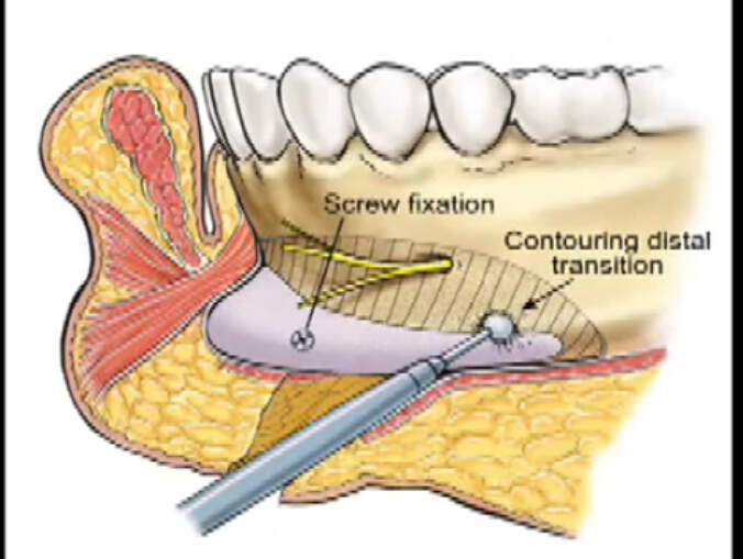 假体植入式隆下巴手术
