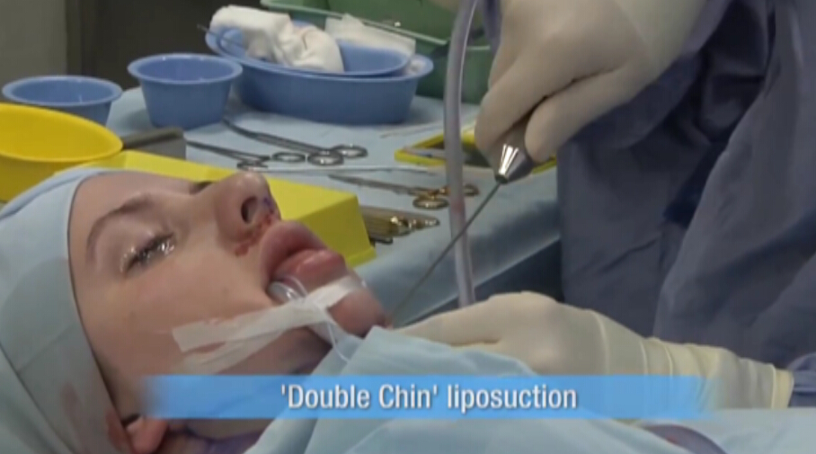 双下巴吸脂术真人体验