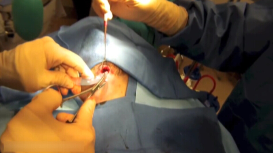 假体隆下颏手术过程