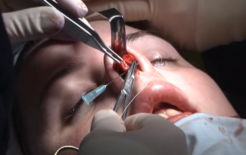 全鼻整形完整手术过程