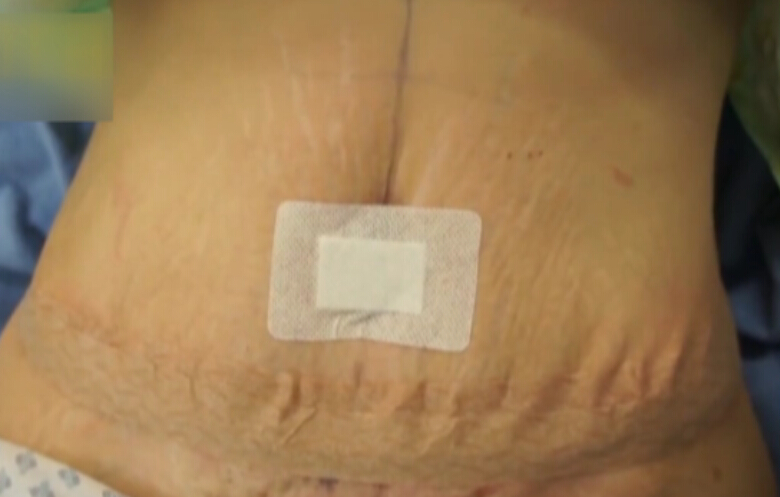 腹部大拉皮手术完整过程