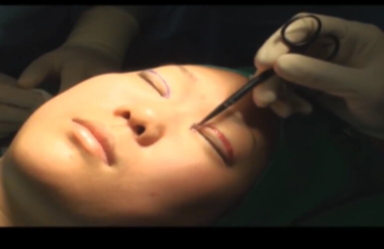 内眦赘皮矫正重睑手术全过程