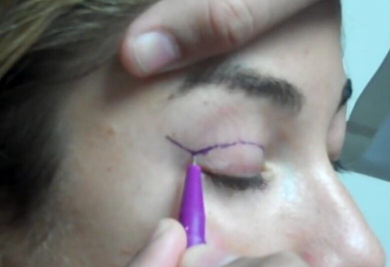 术前做上睑皮肤标记线