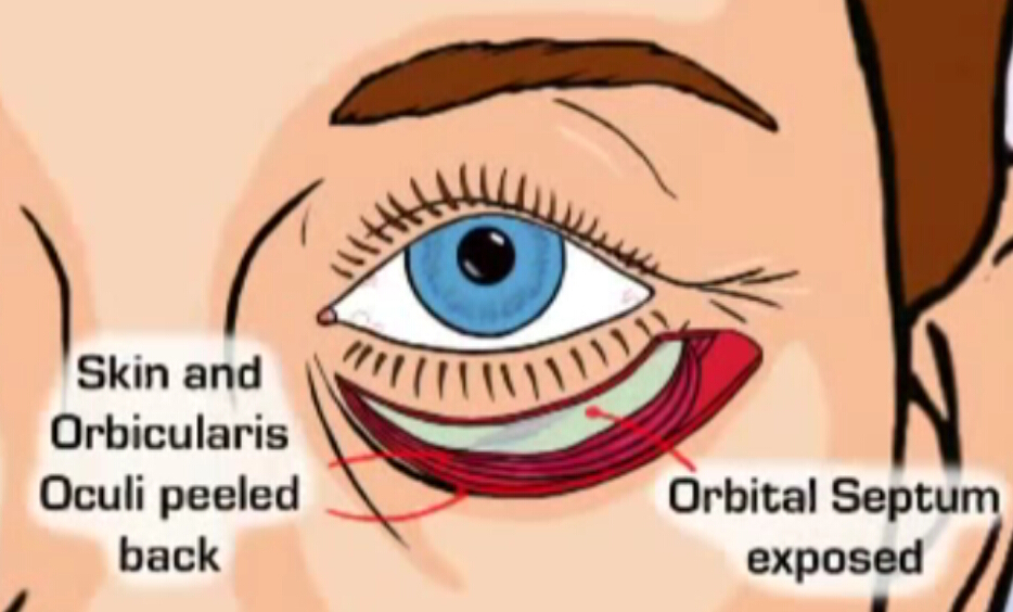 重睑成形术 眼袋祛除术