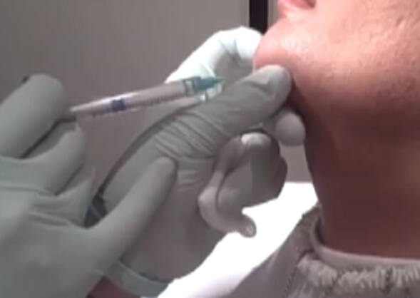 注射填充下巴使得更饱满