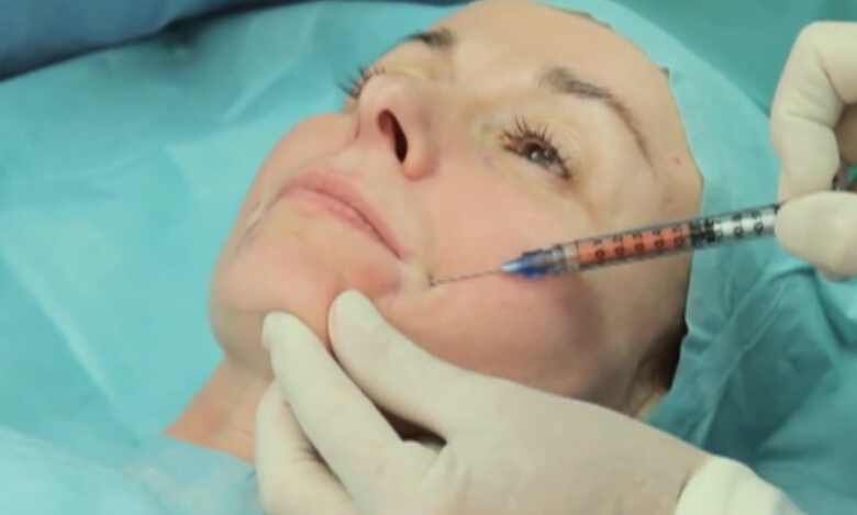 自体脂肪移植面部填充术