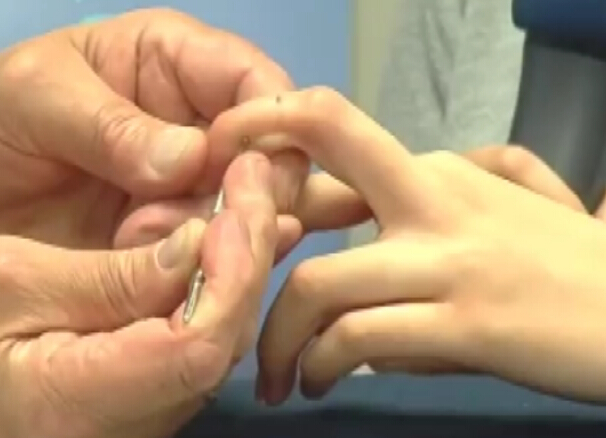 朝鲜方面治疗示范颈部疼痛 在线针刺