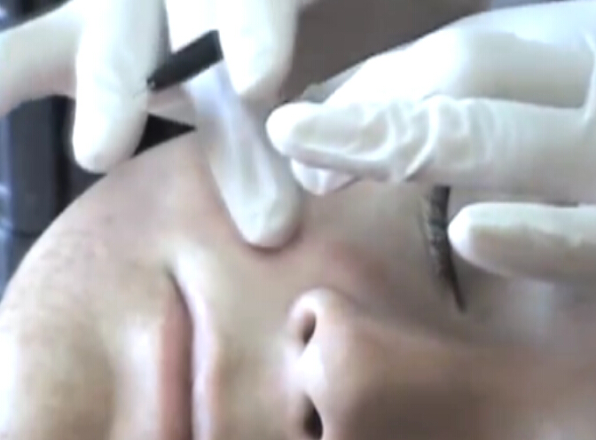 痤疮皮肤囊肿的经典治疗