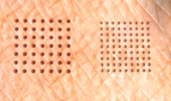 像素激光的作用原理