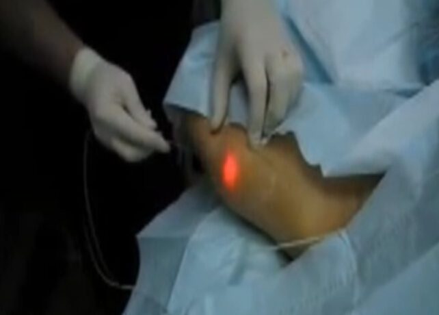 印度上臂光纤溶脂术