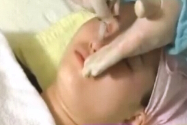 电动微针治疗操作过程