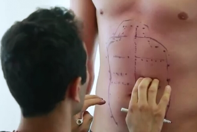 腹部细微脂肪抽吸术