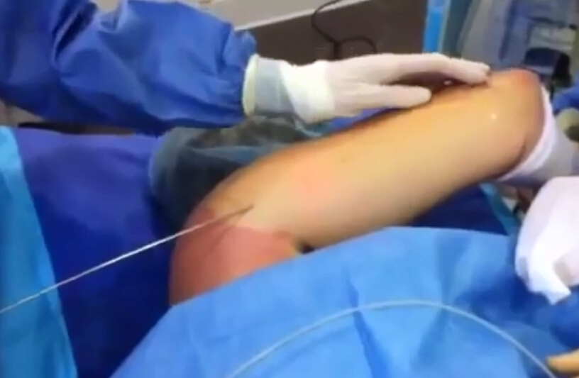 激光溶脂紧致上臂去除蝴蝶袖