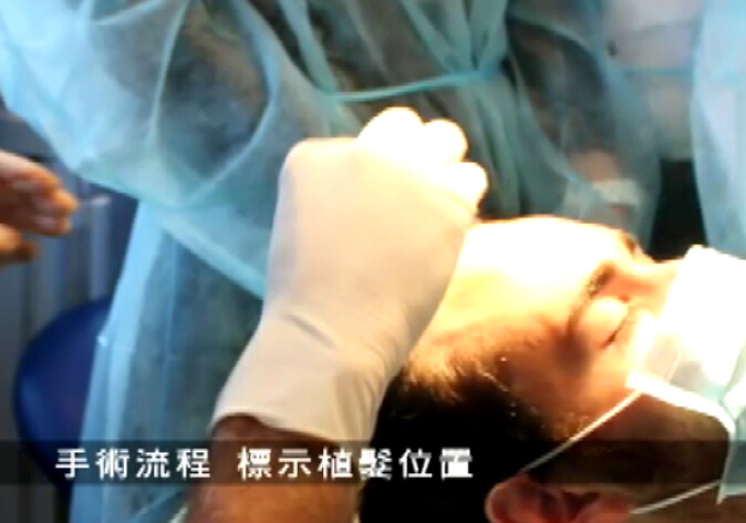 植发不必切头皮 法式无痕自动植发新技术