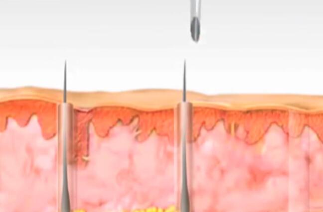 头发移植头发FUE技术-永远作为未来技术