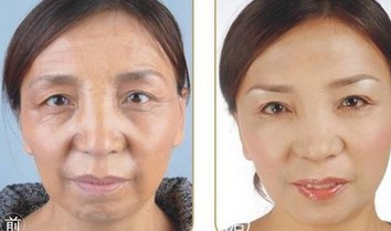 玻尿酸面部除皱对比图