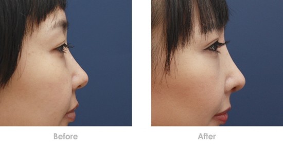 玻尿酸隆鼻前后对比图
