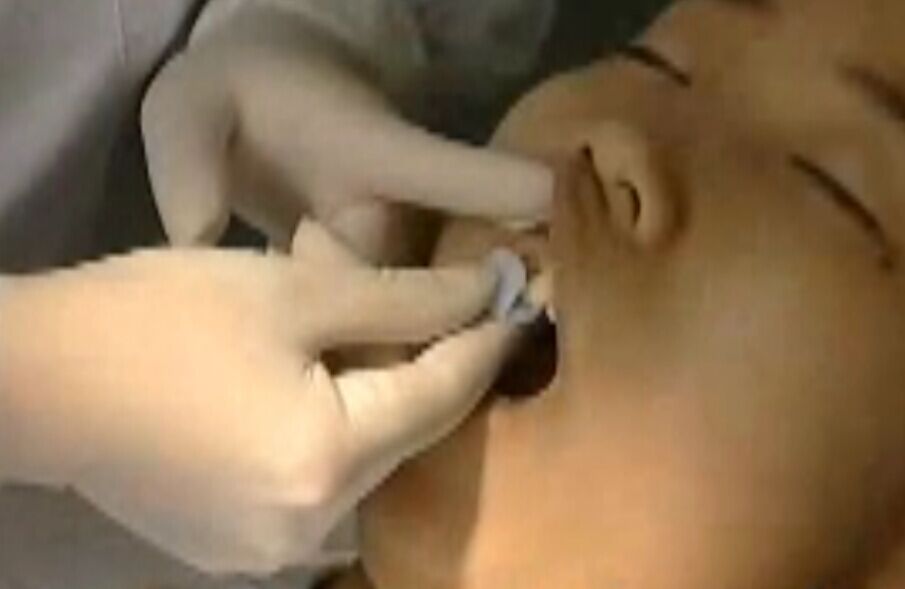 种植牙手术全过程真人演示