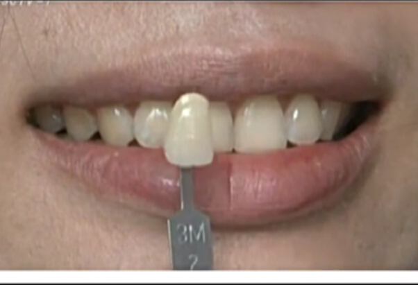 生活调查之牙齿美白大调查