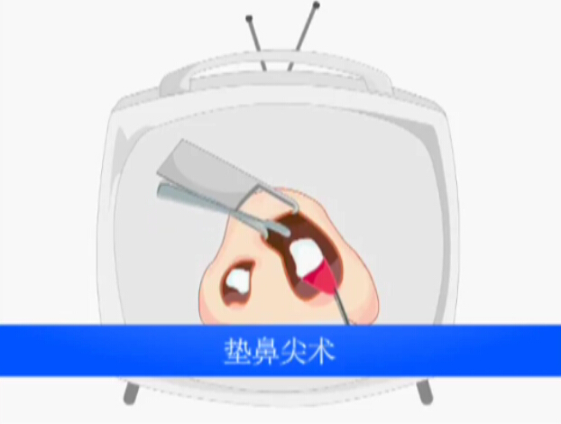 鼻部整形之垫鼻尖术动画演示视频