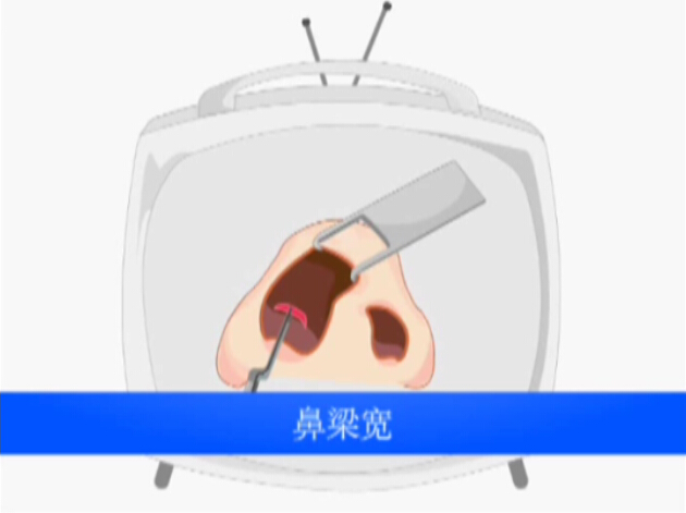 鼻整形手术宽鼻梁缩窄动画演示视频