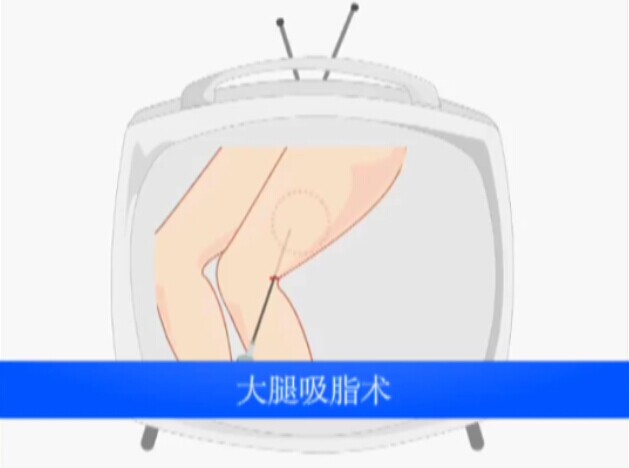 大腿吸脂术动画演示视频