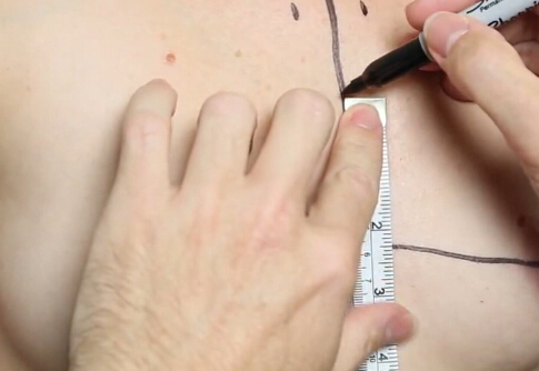 国外隆胸前标记画点真人演示