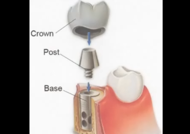 口腔种植牙动画演示过程