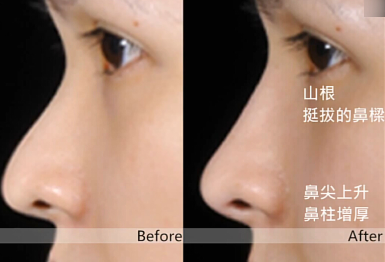 玻尿酸8点注射拉提前后对比